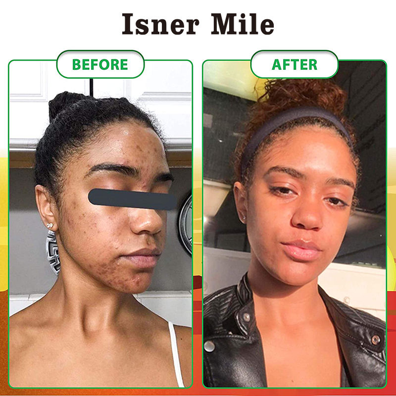 Natural Organic Soap Acne Treatment Dark Spot Remover African Black Soap