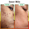 Natural Organic Soap Acne Treatment Dark Spot Remover African Black Soap